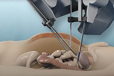 Roboter-assistierte Zystektomie im Krankenhaus Düren